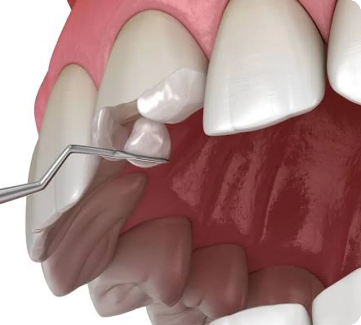 Chipped Tooth Repair (Broken Tooth Repair) Chipped Tooth Repair (Broken Tooth Repair)