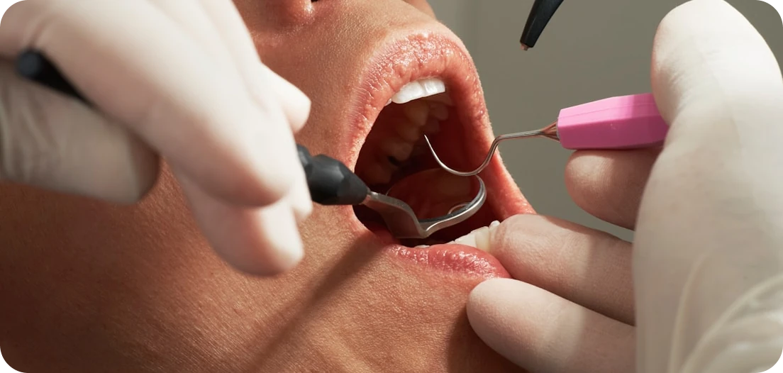 Close-up of dentist using dental instruments inside a patient’s mouth.