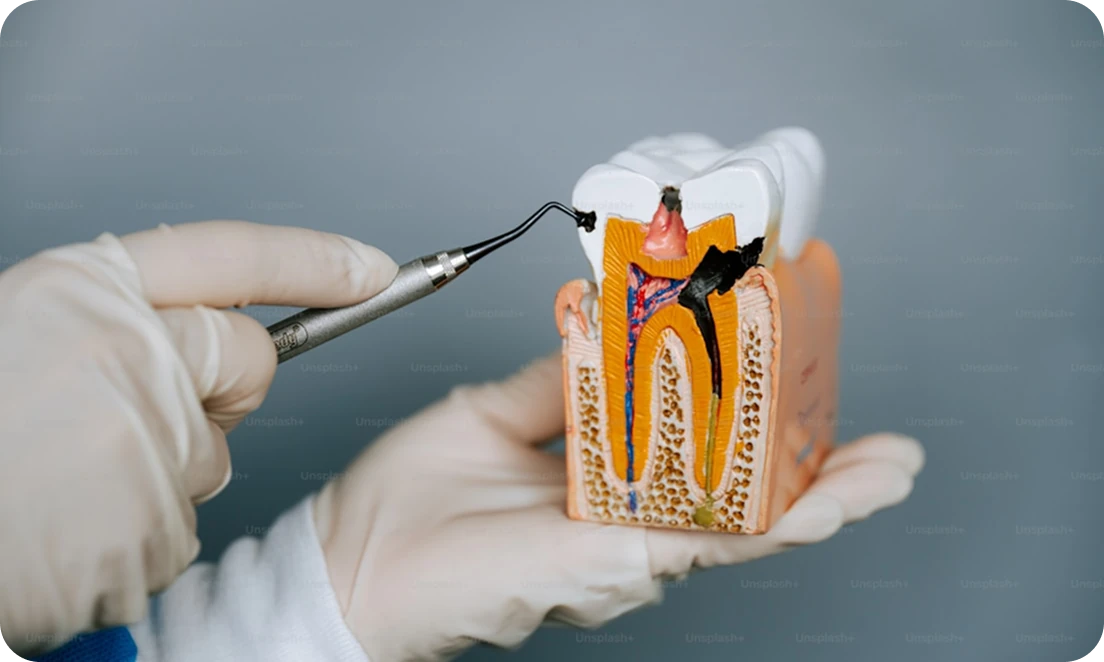 Dental model showing root canal anatomy with dentist using dental tool.