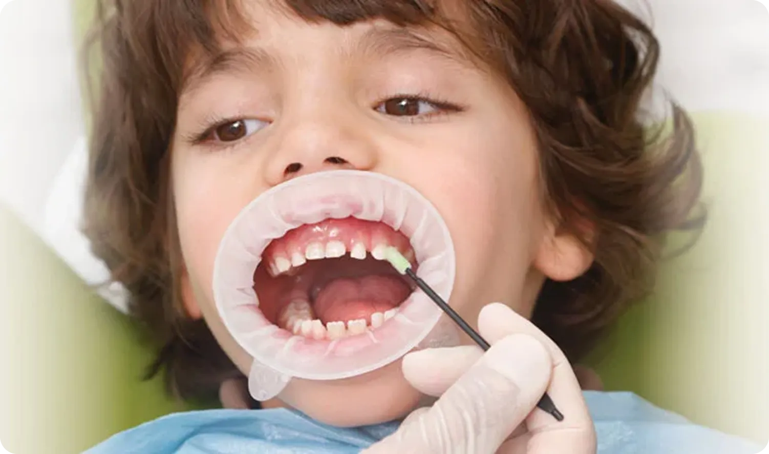 Pediatric Dentistry in Burnaby