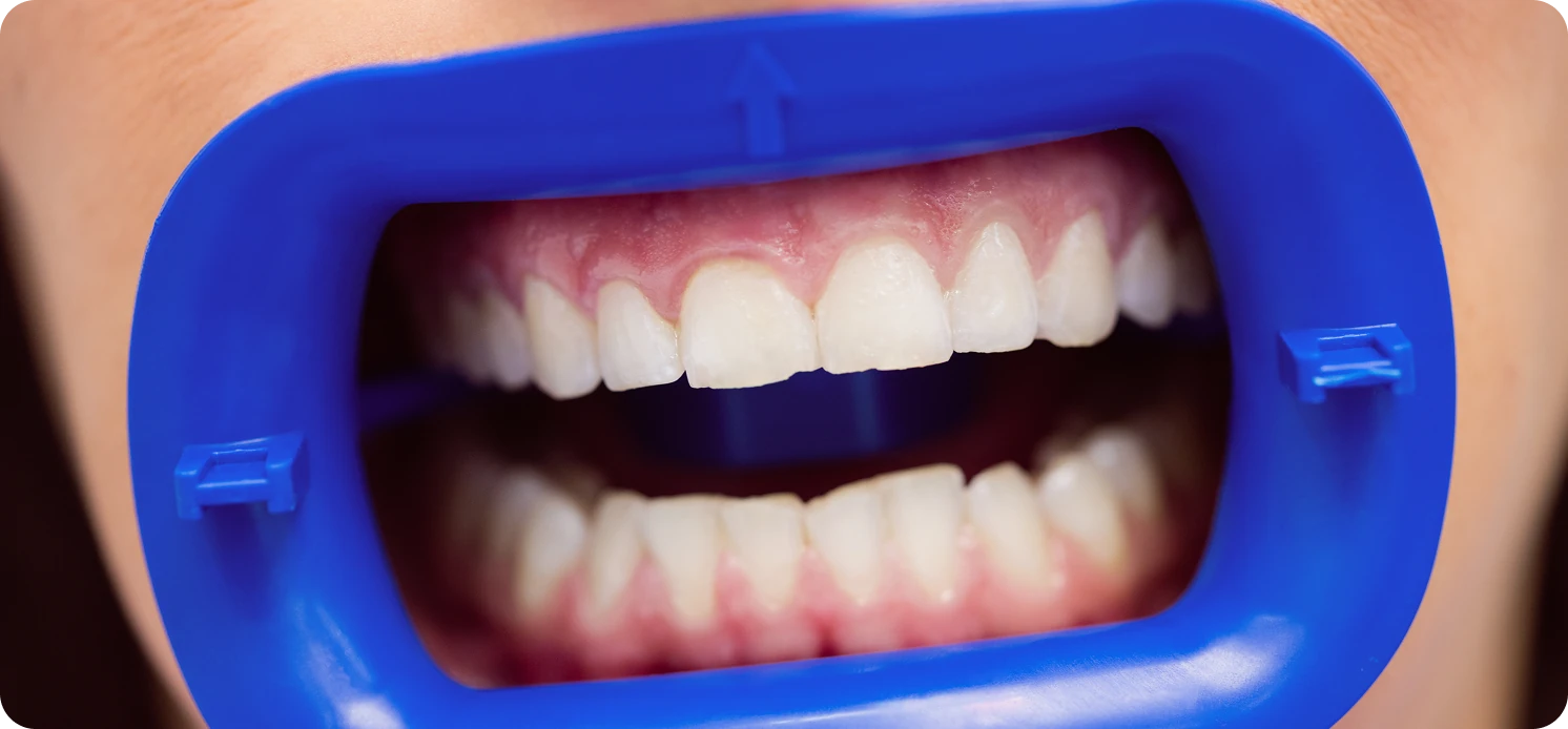 Close-up of patient’s mouth with a blue dental cheek retractor showing teeth and gums before treatment.