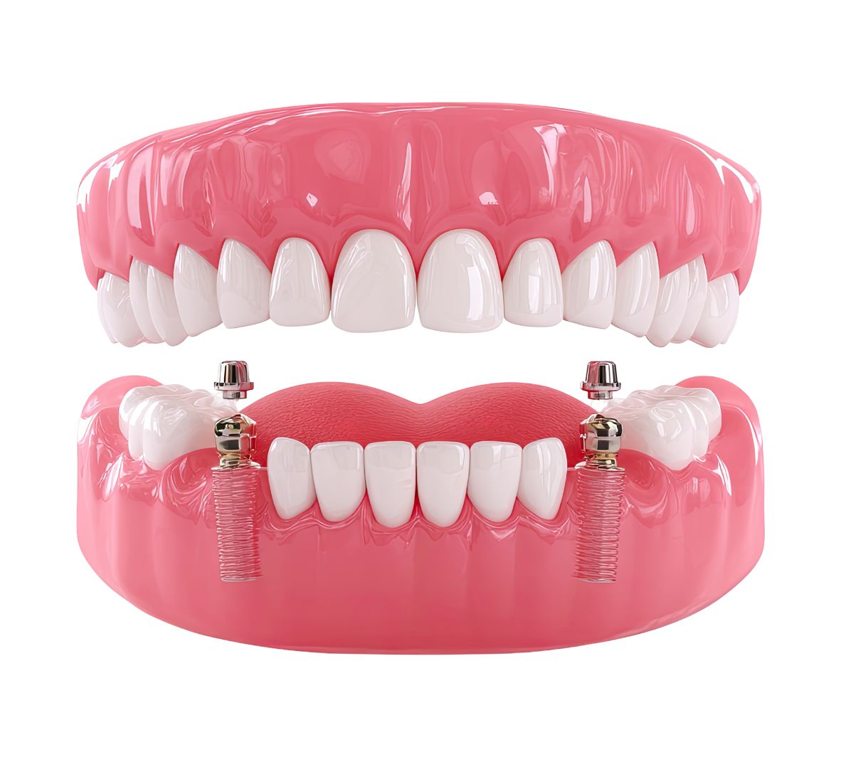 snap-in dentures