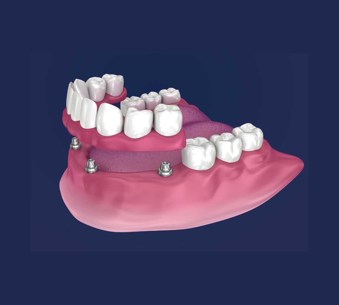 Bar-Retained Overdentures