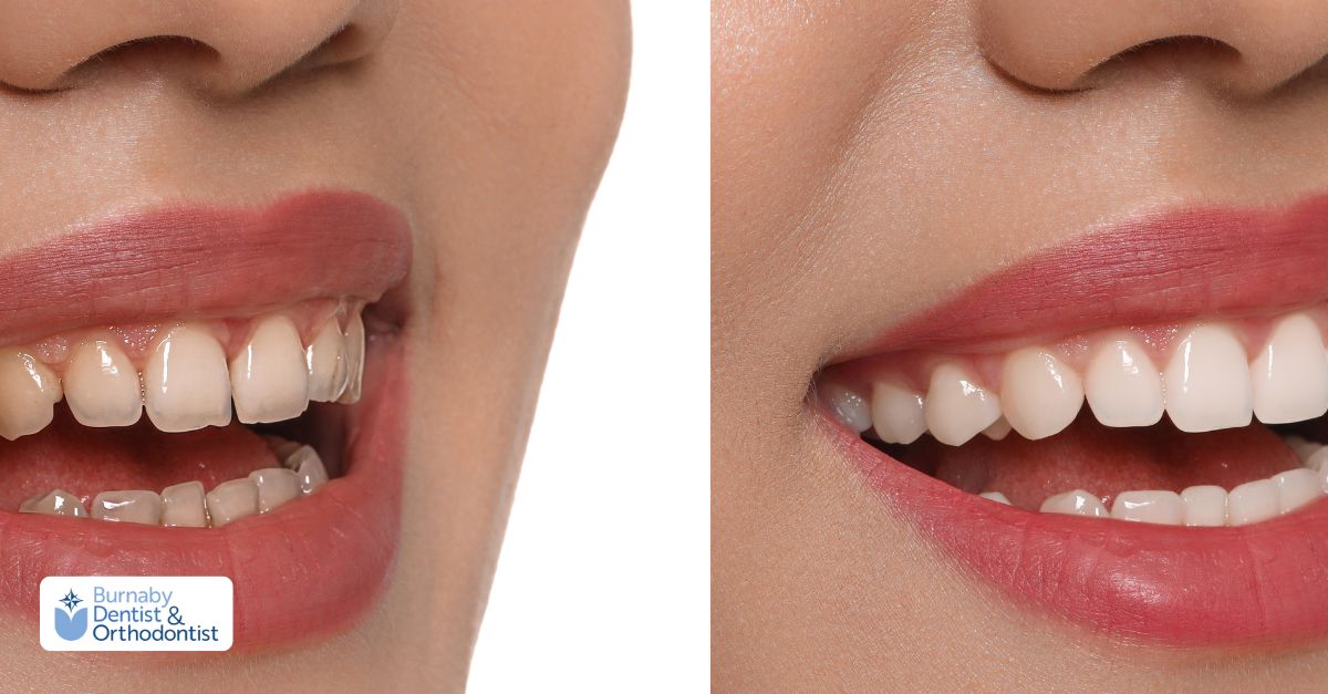 Before and after images of a dental bridge for front teeth
