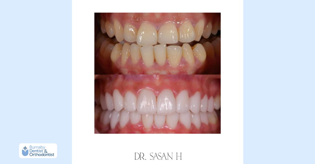 Smile transformation with veneers correcting spacing and discoloration.
