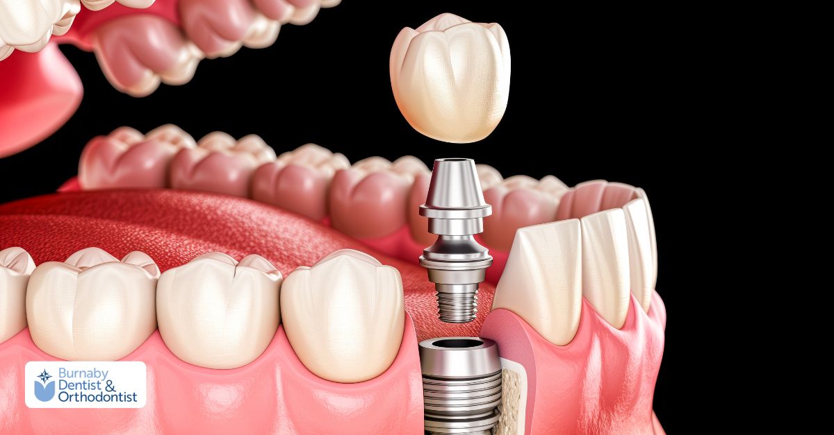  Depition of dental implant and jawbone
