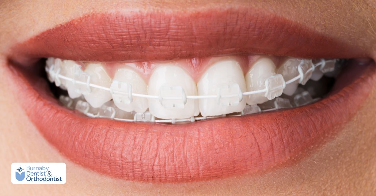 Close-up of clear ceramic braces blending with natural teeth