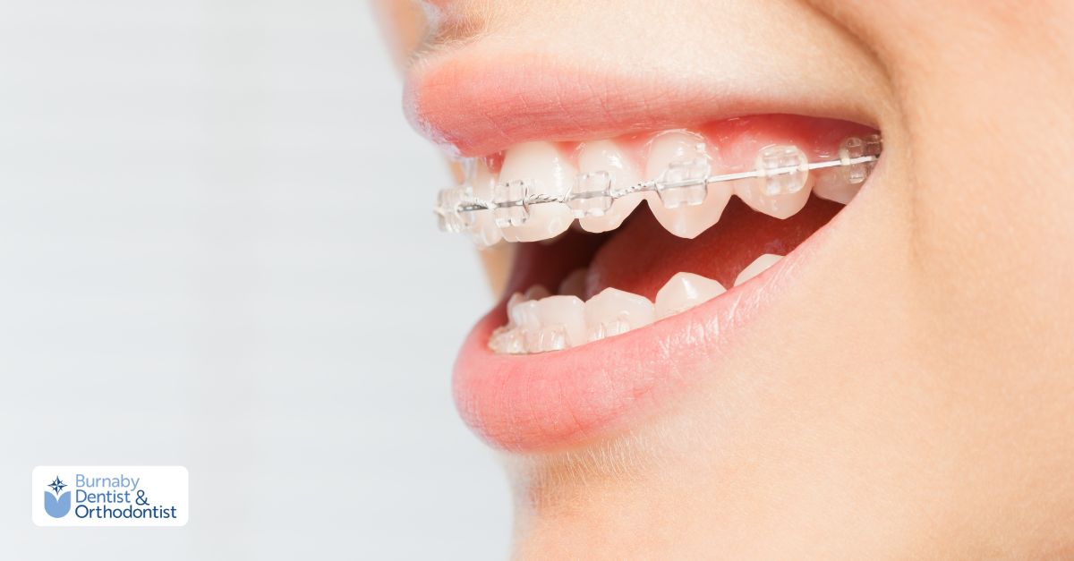 Clear ceramic braces as a less visible alternative to metal braces