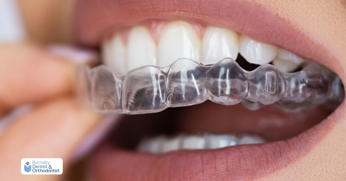 Selecting between Invisalign clear aligners and traditional braces