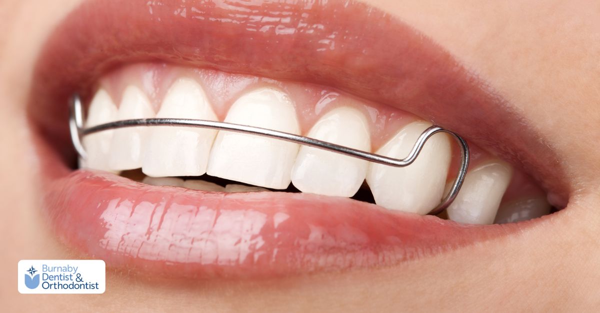 Close-up of fixed orthodontic retainer highlighting the need for cleaning and flossing