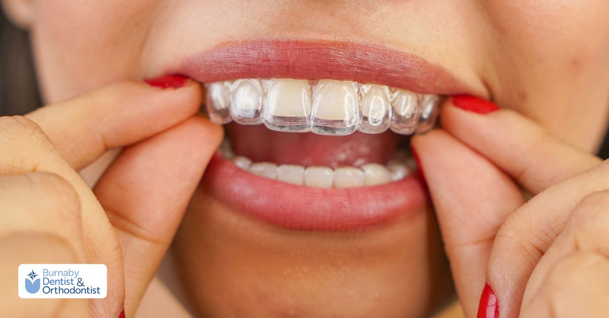 Close-up of clear aligners being fitted over teeth for discreet orthodontic correction.