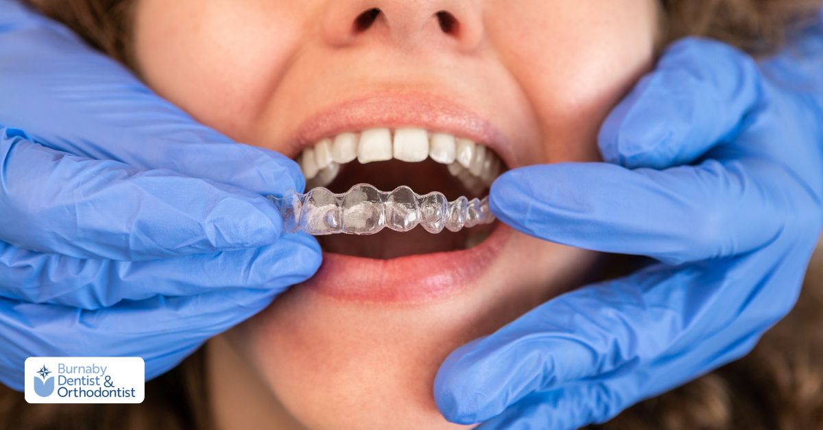 Close-up of Invisalign clear aligners being fitted during orthodontic treatment.