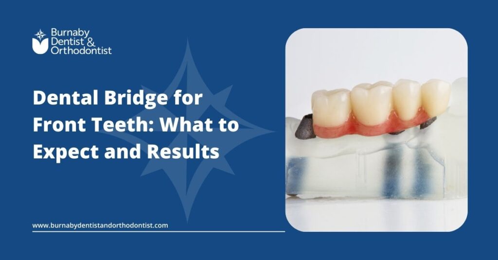 Dental Bridge for Front Teeth: What to Expect in 2025