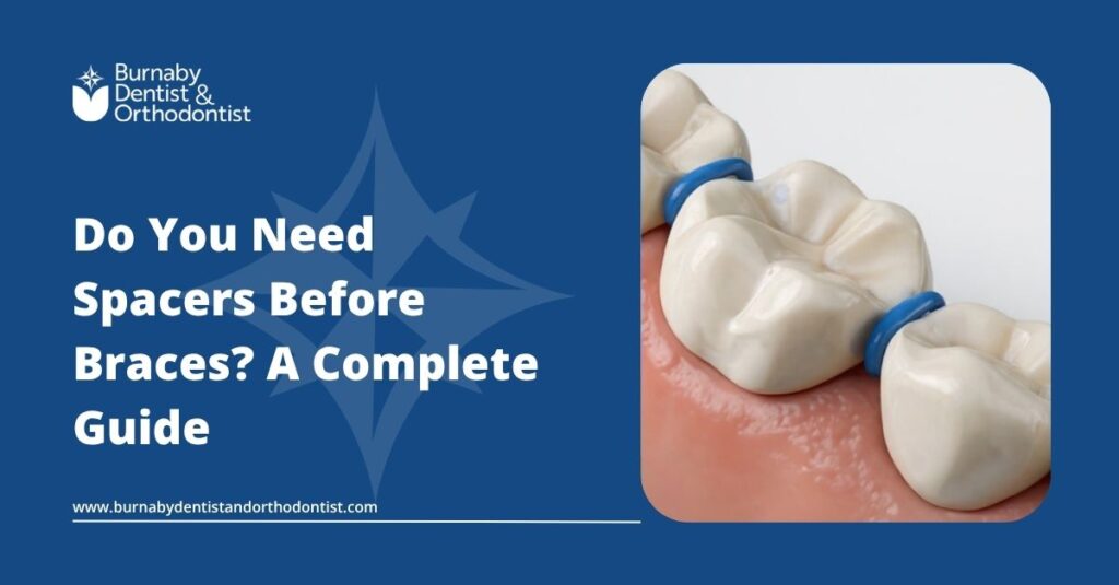 Dental model showing blue spacers between molars, used before braces placement.