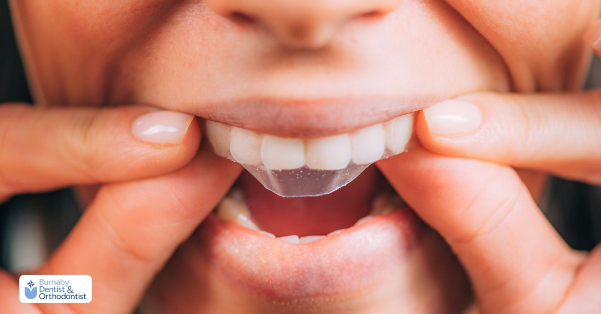 A person using over-the-counter whitening strips
