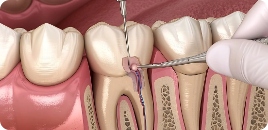 Infected Tooth? Get Trusted Root Canal Care in Burnaby