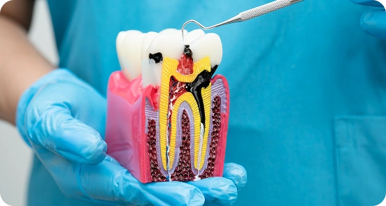 Signs You Might Need a Dental Filling
