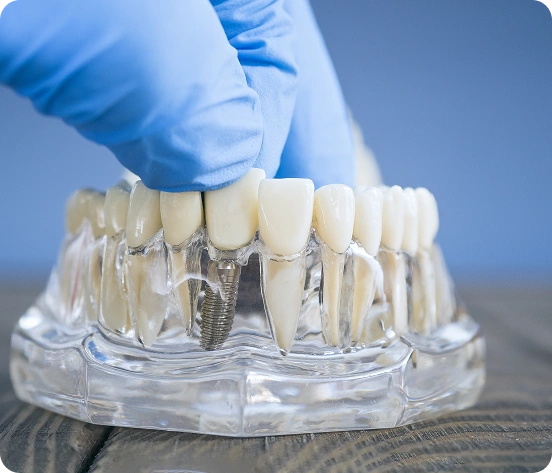 How Long Do Dental Implants Last?