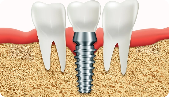 Benefits of Choosing Dental Implants Over Bridges or Dentures