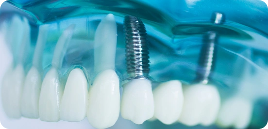 Natural-Looking Dental Implants in Burnaby | Book Your Consultation