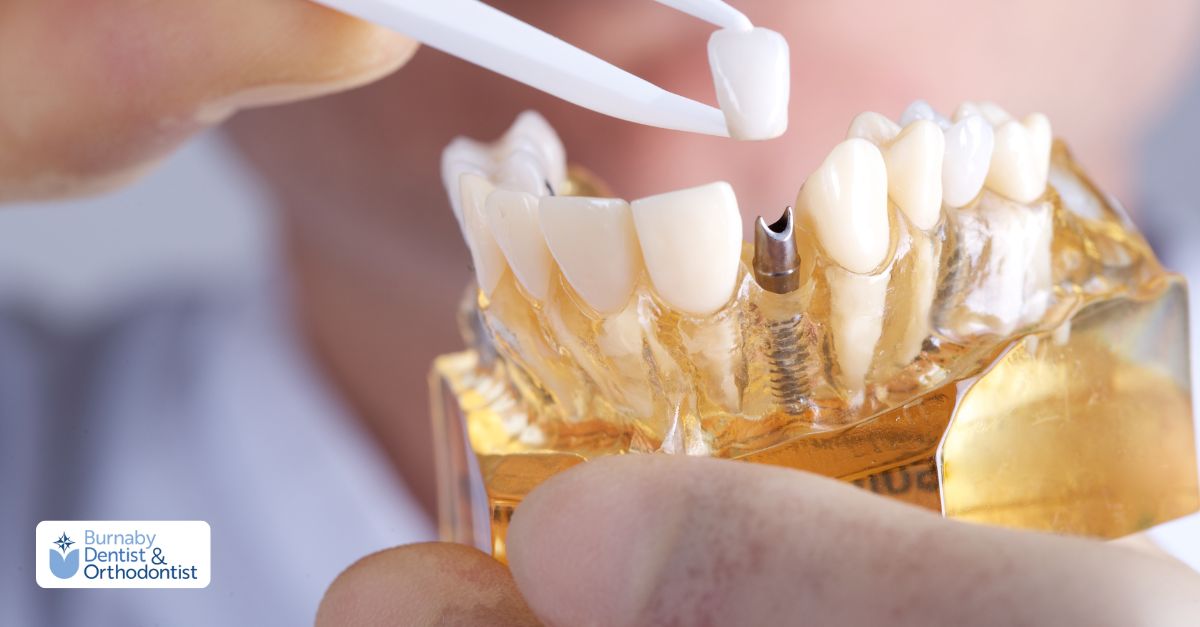 A dental implant is being carefully placed into a tooth during a dental procedure.