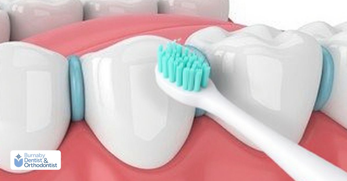 A woman holds a toothbrush in her mouth, demonstrating dental care with orthodontic separators in place.
