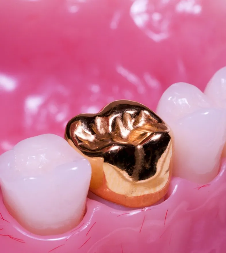 Dental Crowns Dental Crowns