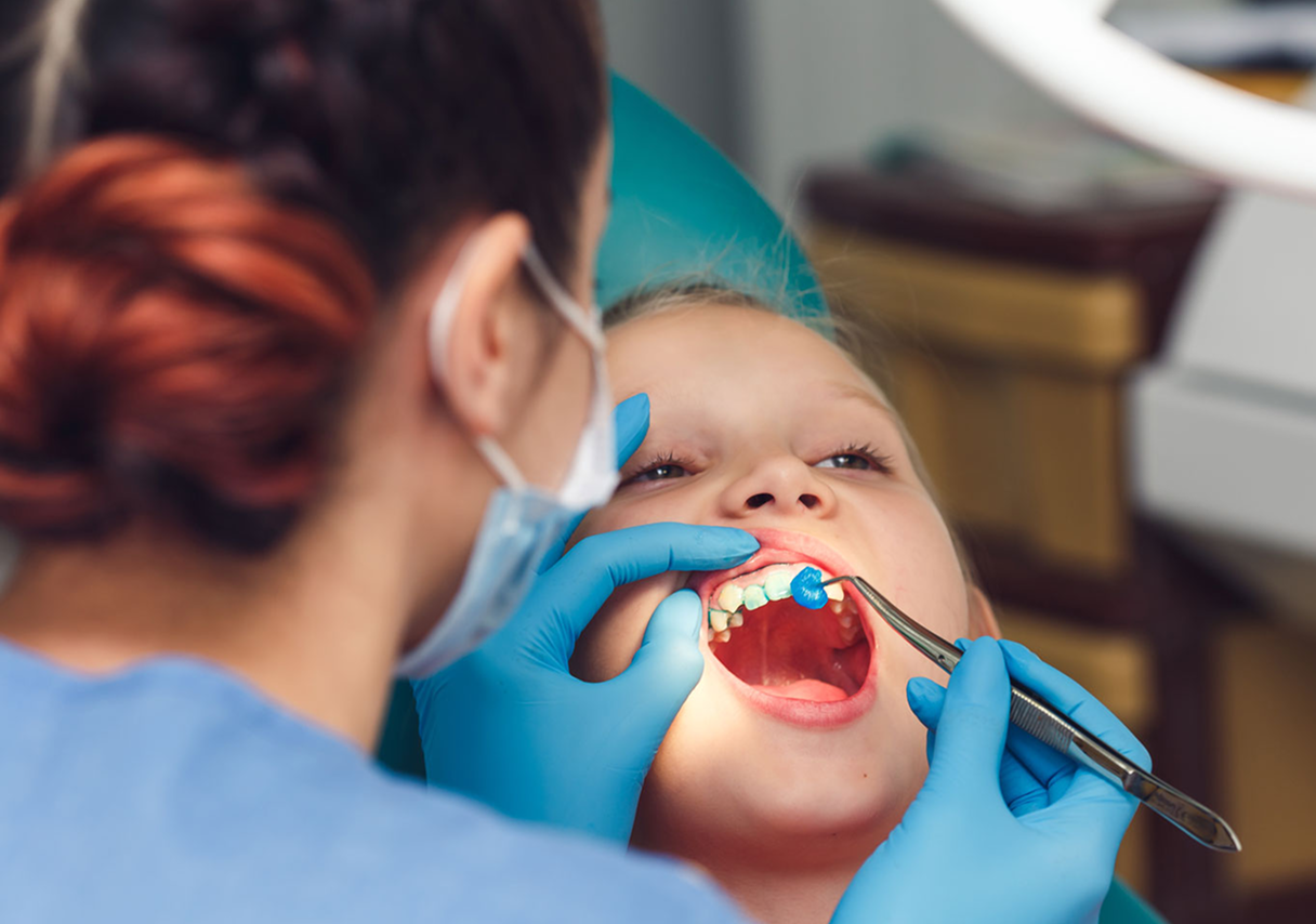 Fluoride Treatment for Kids in Burnaby