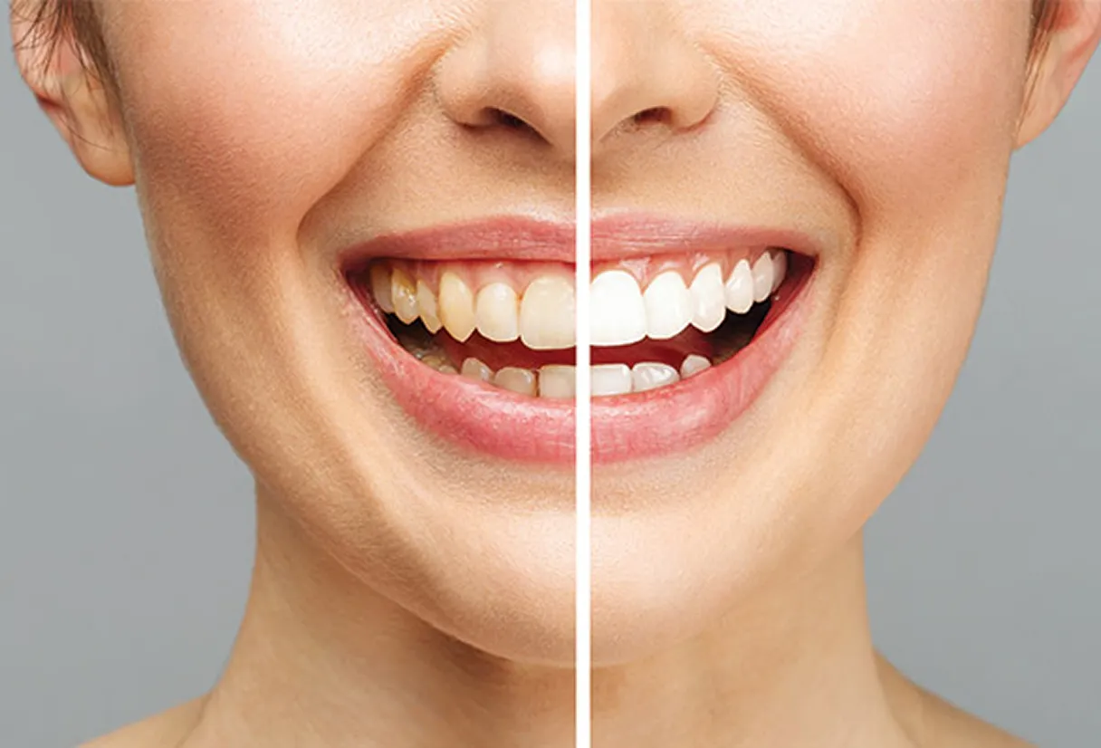 Teeth Whitening in Burnaby