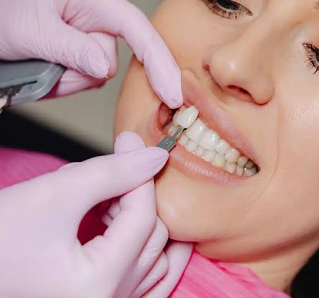 Chipped Tooth Repair (Broken Tooth Repair) Chipped Tooth Repair (Broken Tooth Repair)