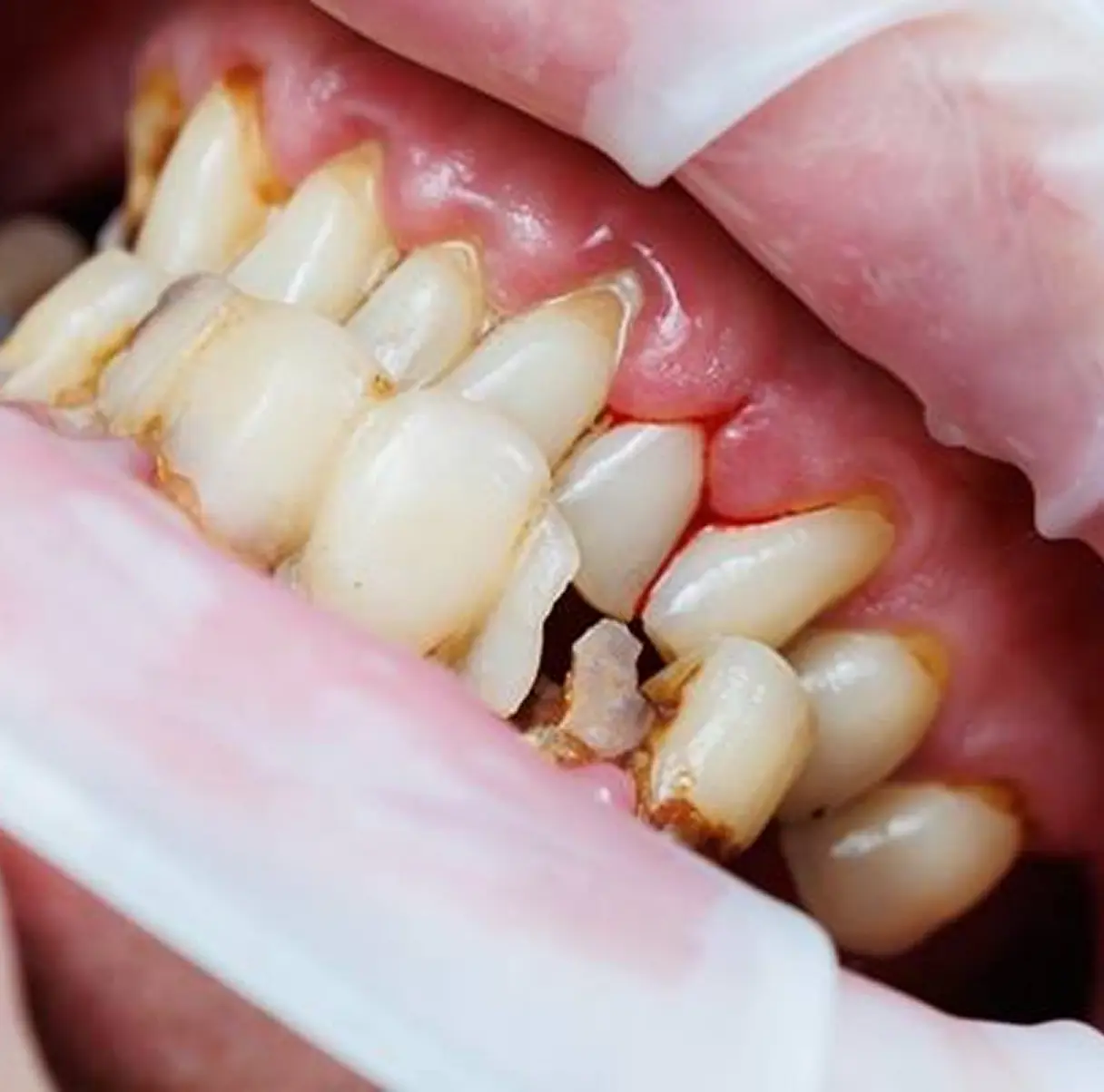 Chipped Tooth Repair (Broken Tooth Repair) Chipped Tooth Repair (Broken Tooth Repair)