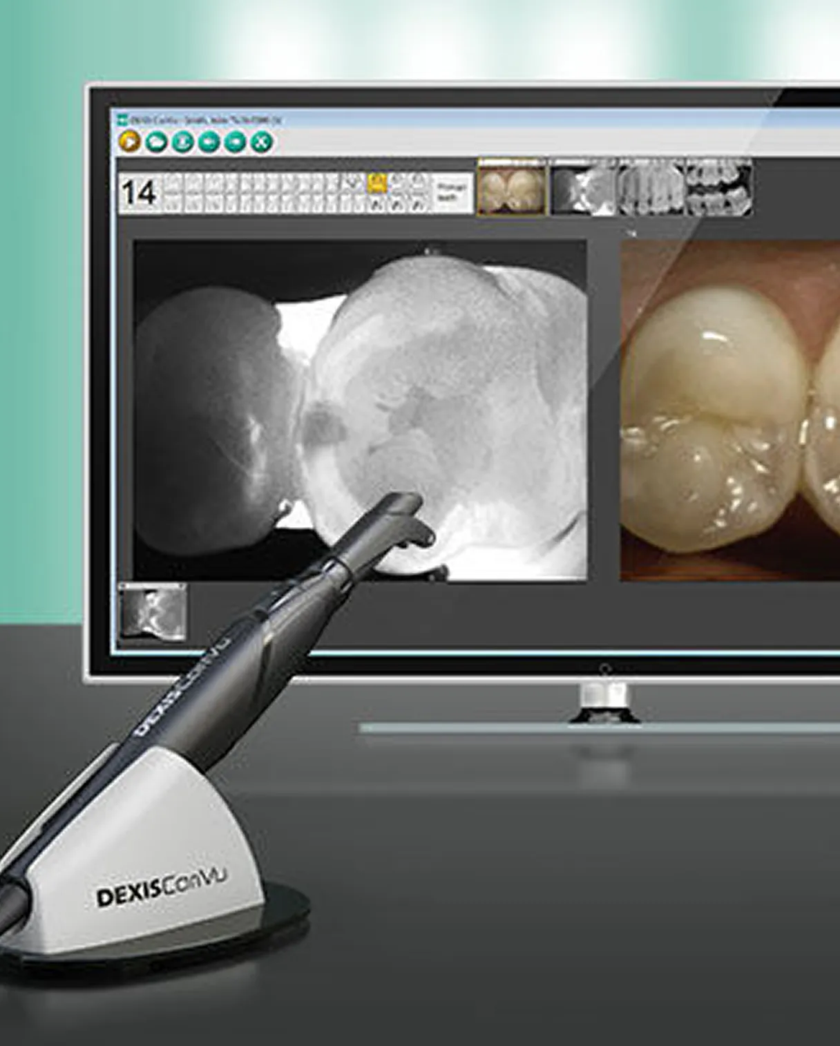 Caries detection devices (iTero, Niri, DIAGNOCat)