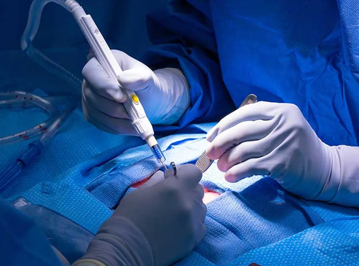 Electrosurgery (Bovie) Electrosurgery (Bovie)