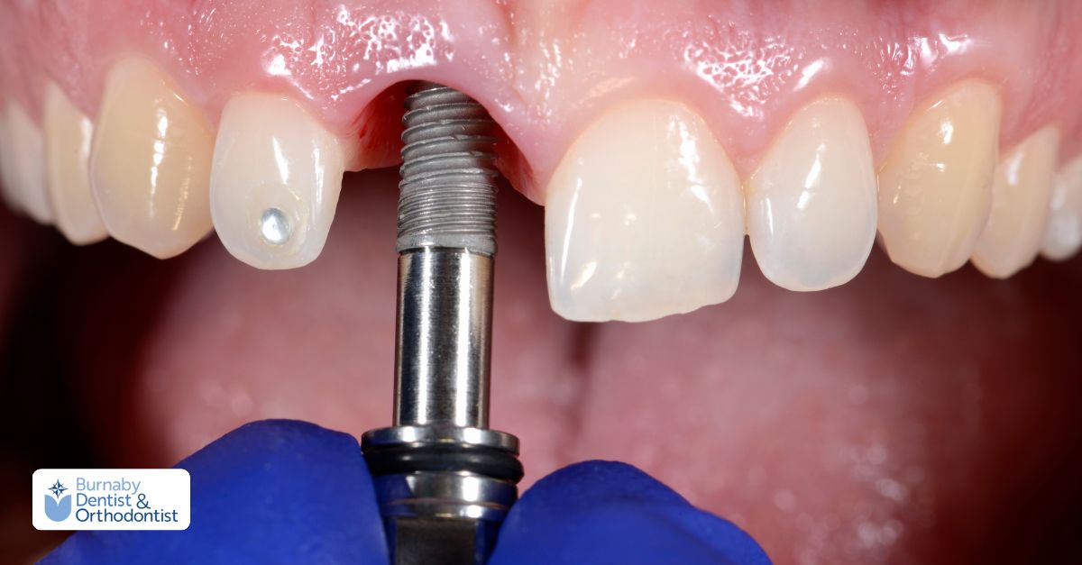  Dental implant surgery showing precise placement of the implant post into the jawbone.