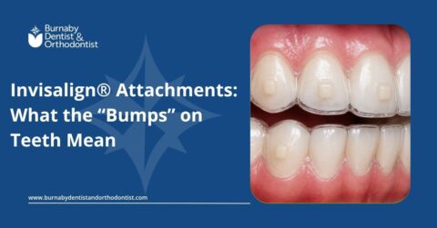 Attachments typically stay on for most or all of the treatment duration, depending on your plan. They are removed once they are no longer needed.