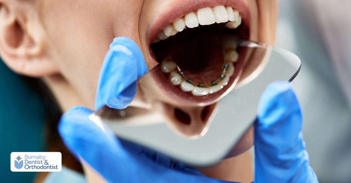 Benefits of lingual braces placed behind the teeth for invisibility