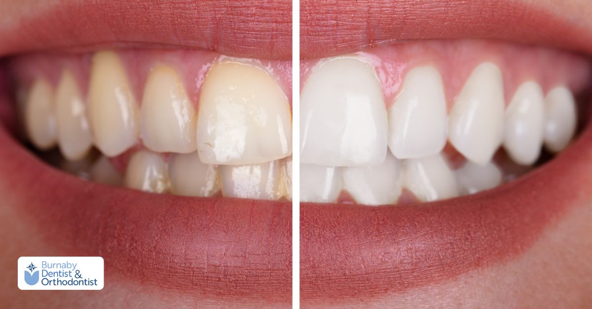 Comparison photos of a woman highlighting her smile transformation from before to after the makeover.