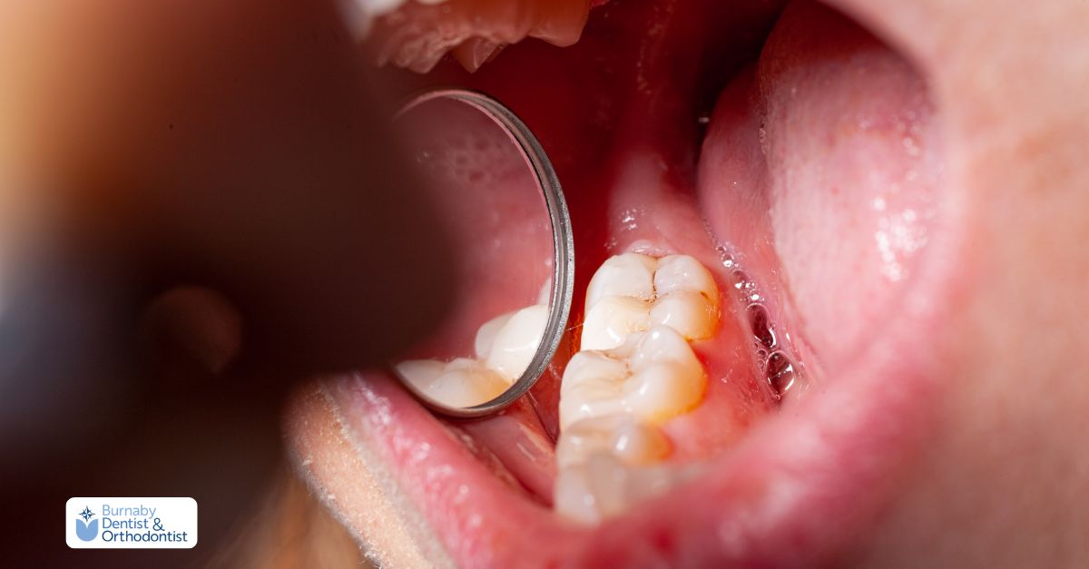 Close-up of infected molar being inspected before root canal treatment.