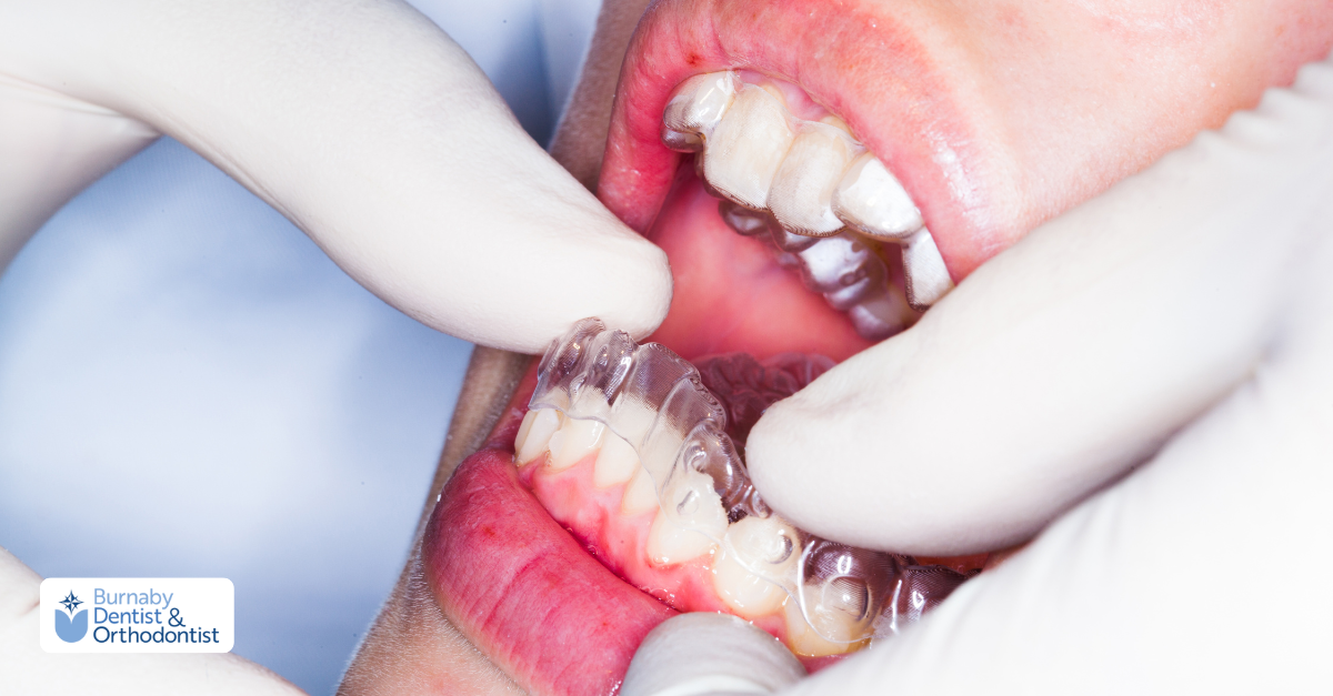  Dentist placing a removable clear retainer over teeth after orthodontic treatment.