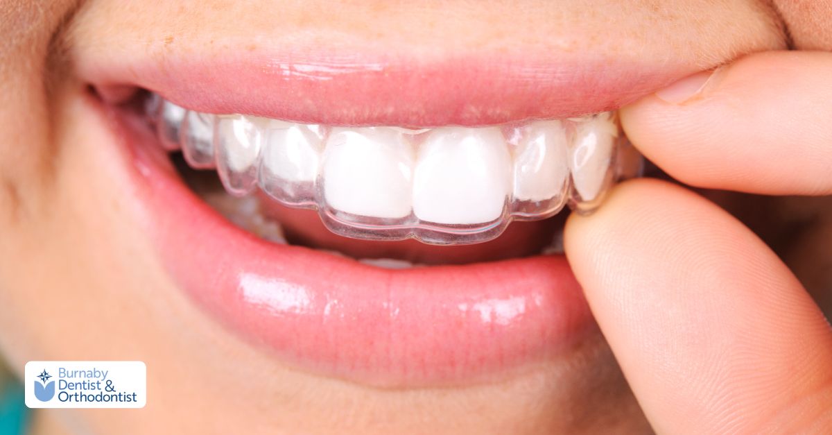 Clear removable retainer being worn on teeth, demonstrating proper retainer care and maintenance.