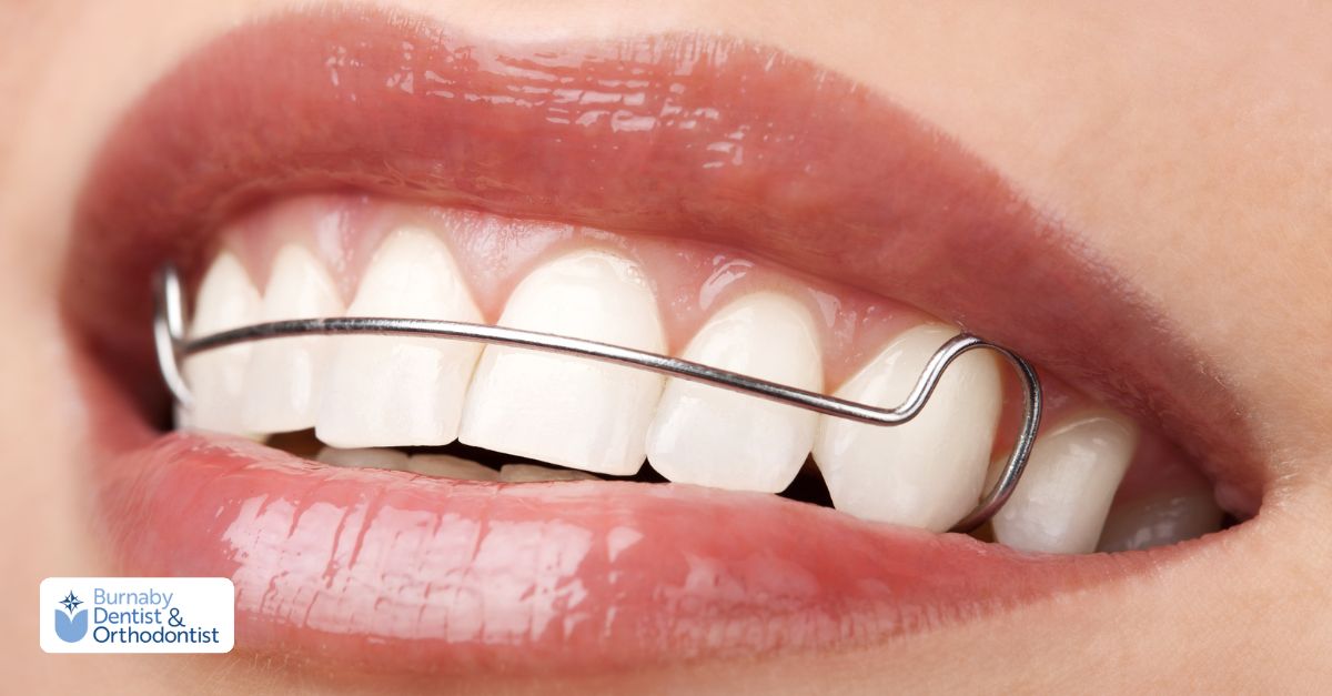 Orthodontic retainer supporting tooth stability after braces