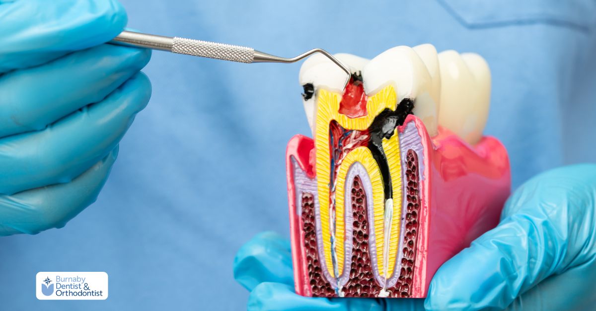 Dental model illustrating internal tooth infection before root canal therapy.