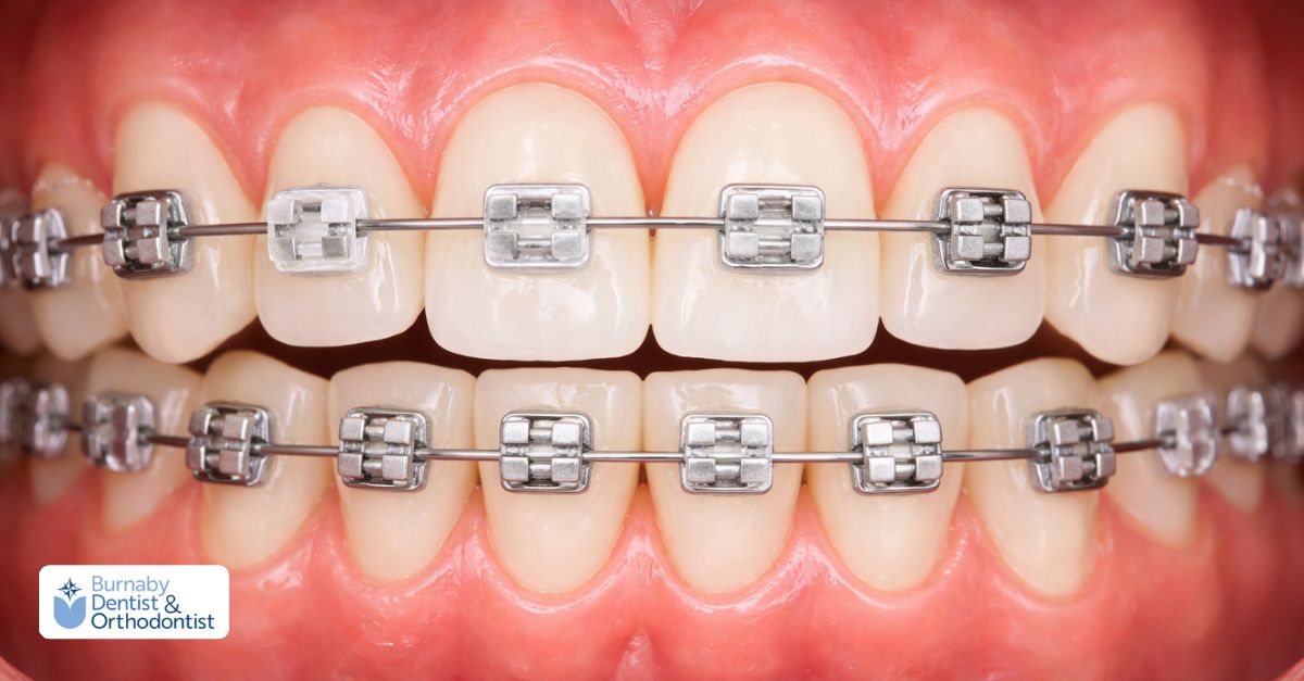 Self-ligating braces with built-in clips for efficient tooth movement