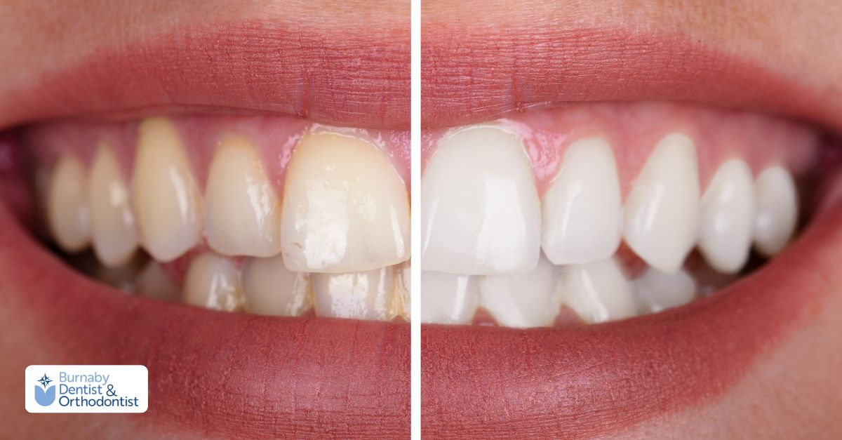 Before and after teeth whitening results showing a brighter, more even smile.