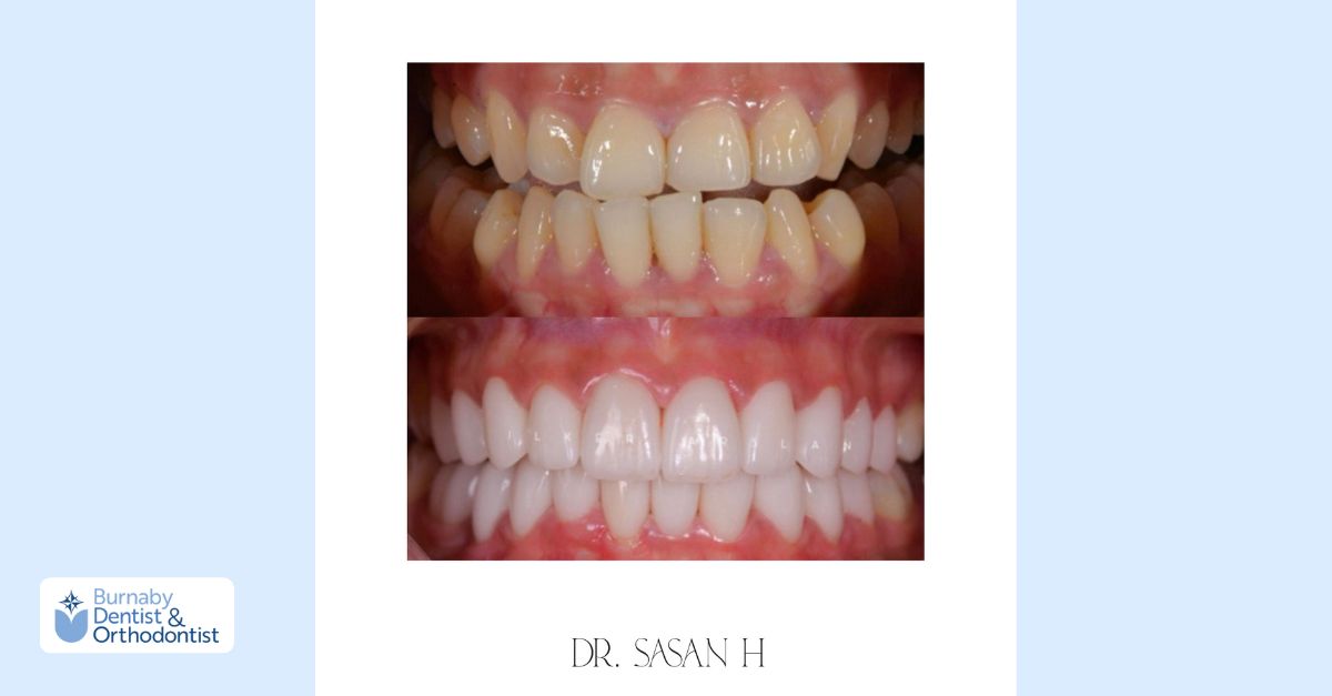 Cosmetic dentistry before and after comparison showing improvements in tooth color, alignment, and overall smile balance.
