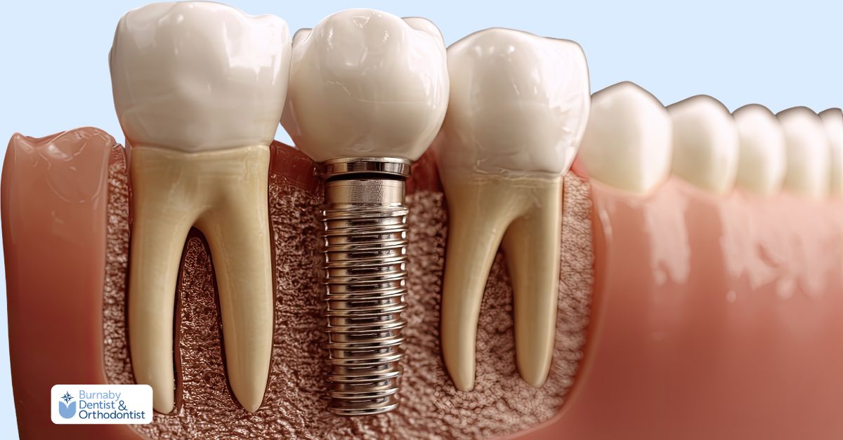 Close-up of a dental model with titanium implants and crowns, illustrating the realities behind dental implants.