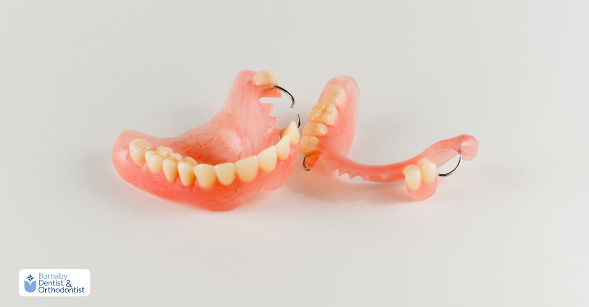 Tooth-supported overdenture attached to remaining natural teeth for added support and stability