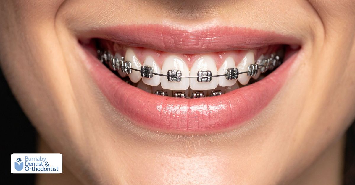 Traditional metal braces on teeth for orthodontic treatment