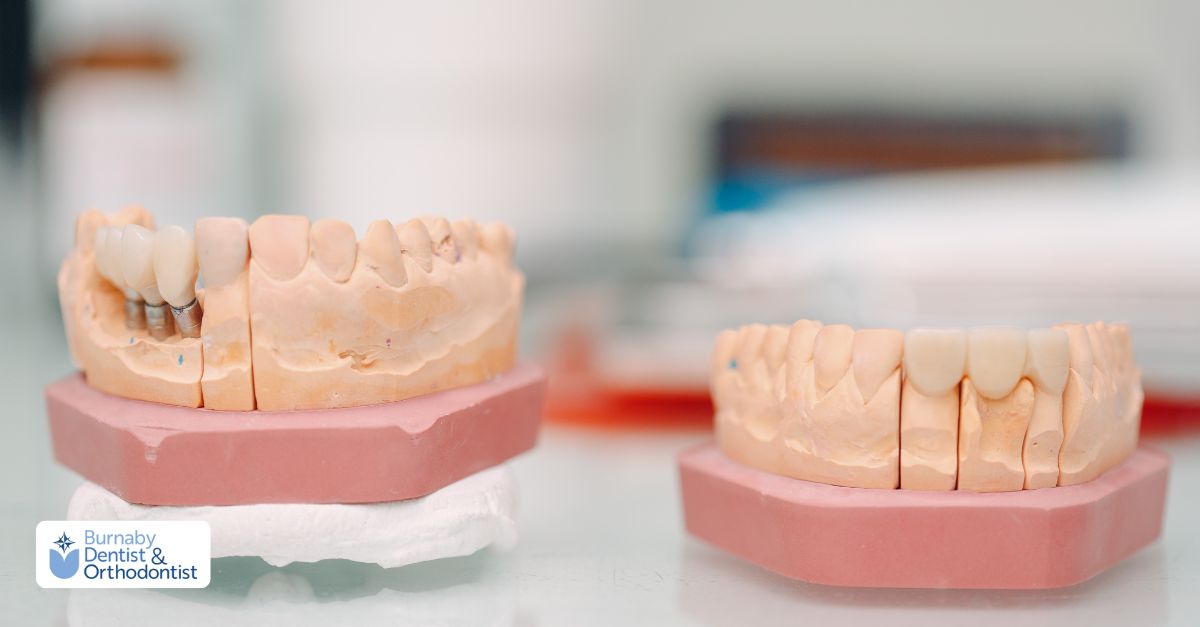 Visual comparison of dental implants and bridges, showcasing their distinct features and benefits for tooth replacement.