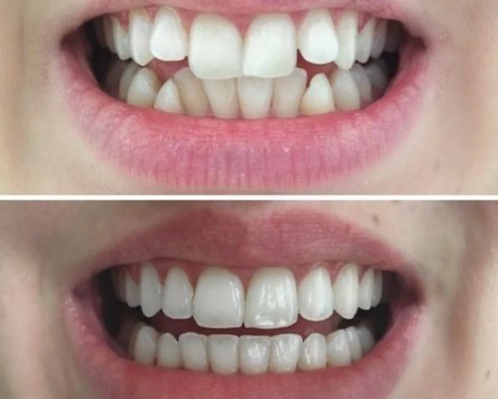vdsc-smile-make-over_before-after-1 2 (1)